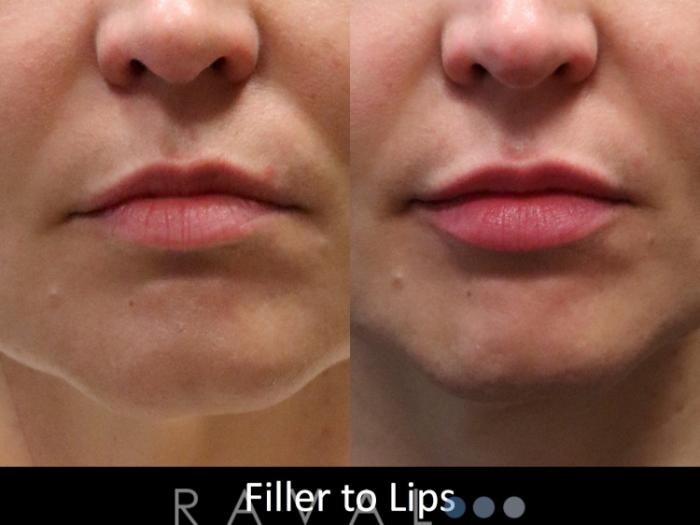 Before & After Botox & Dermal Fillers Case 1133 View 1 View in Denver, CO