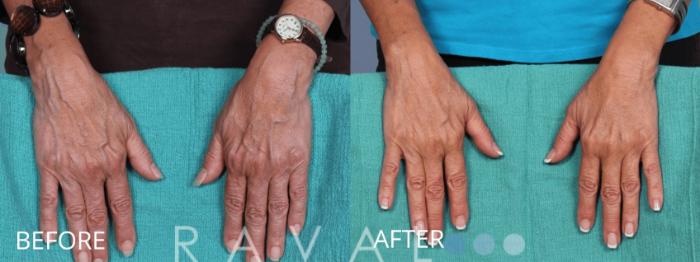 Before & After Botox & Dermal Fillers Case 1139 View 1 View in Denver, CO
