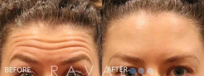 Before & After Botox & Dermal Fillers Case 1147 View 1 View in Denver, CO