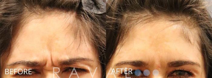 Before & After Botox & Dermal Fillers Case 1158 View 1 View in Denver, CO