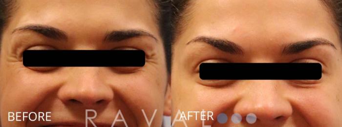Before & After Botox & Dermal Fillers Case 1176 View 1 View in Denver, CO