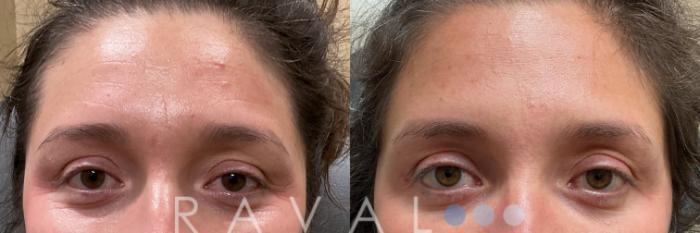 Before & After Botox & Dermal Fillers Case 1186 View 1 View in Denver, CO