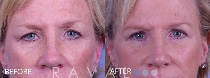 Before & After Eyelid Lifts Case 1069 View 1 View in Denver, CO