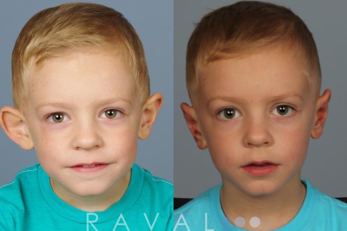 Before & After Otoplasty Case 1082 View 1 View in Denver, CO