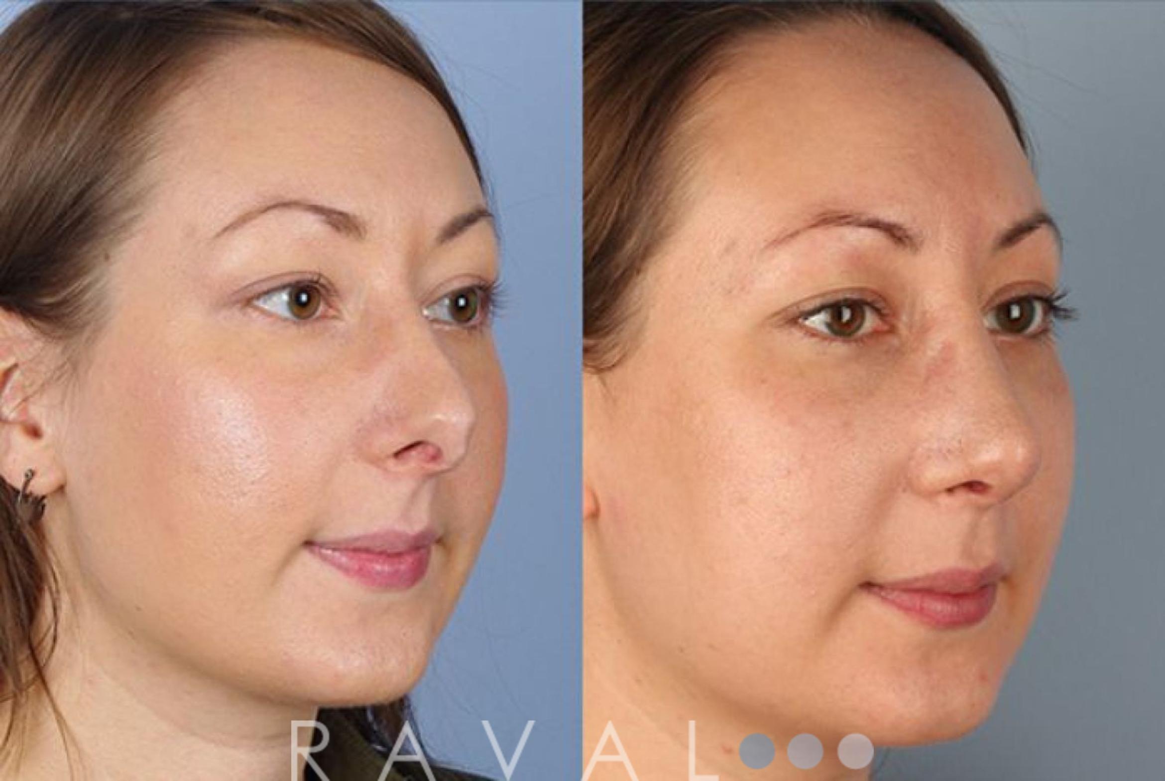 Before & After Revision Rhinoplasty Case 1049 View 1 View in Denver, CO