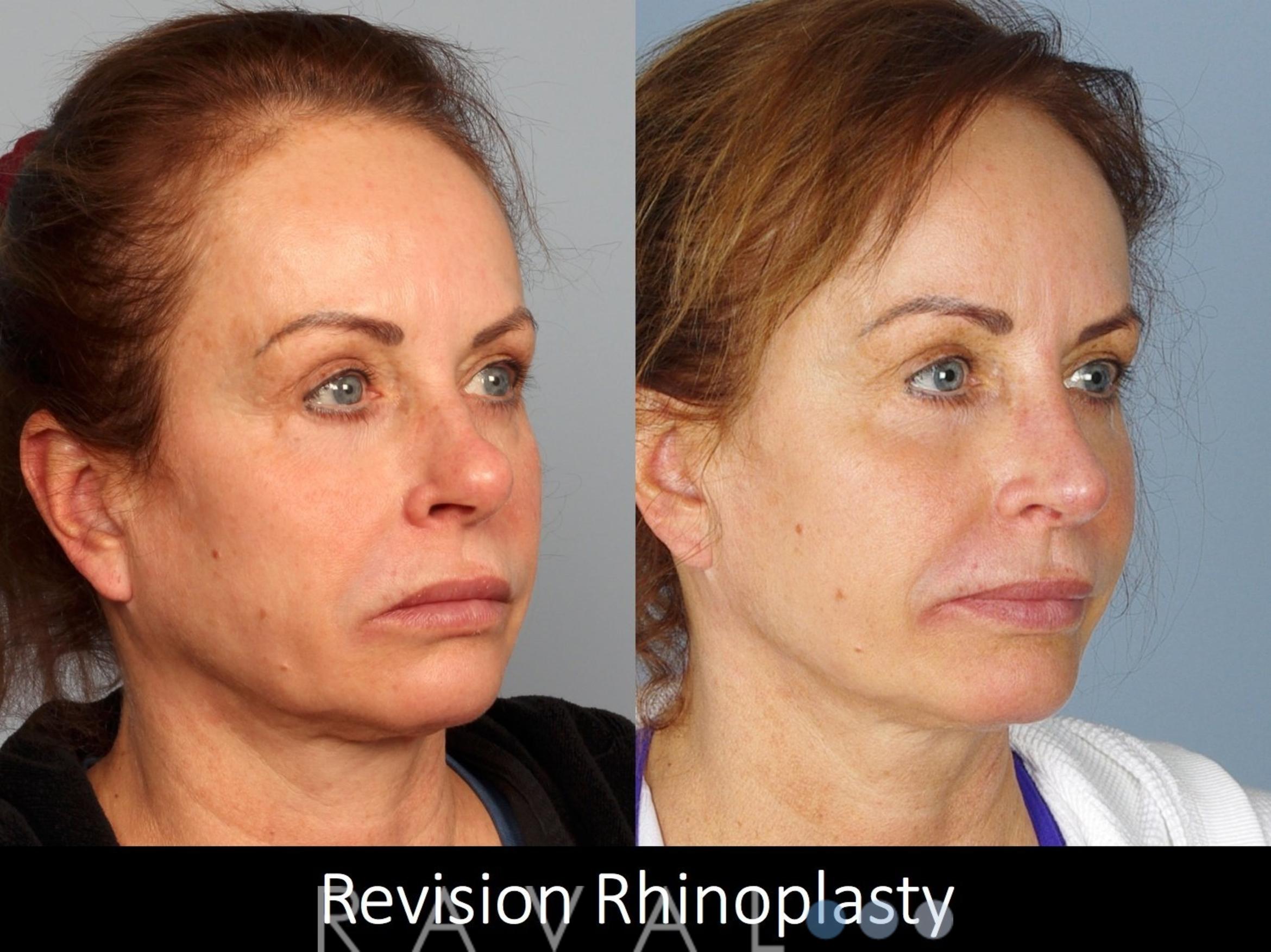 Before & After Revision Rhinoplasty Case 1050 View 1 View in Denver, CO