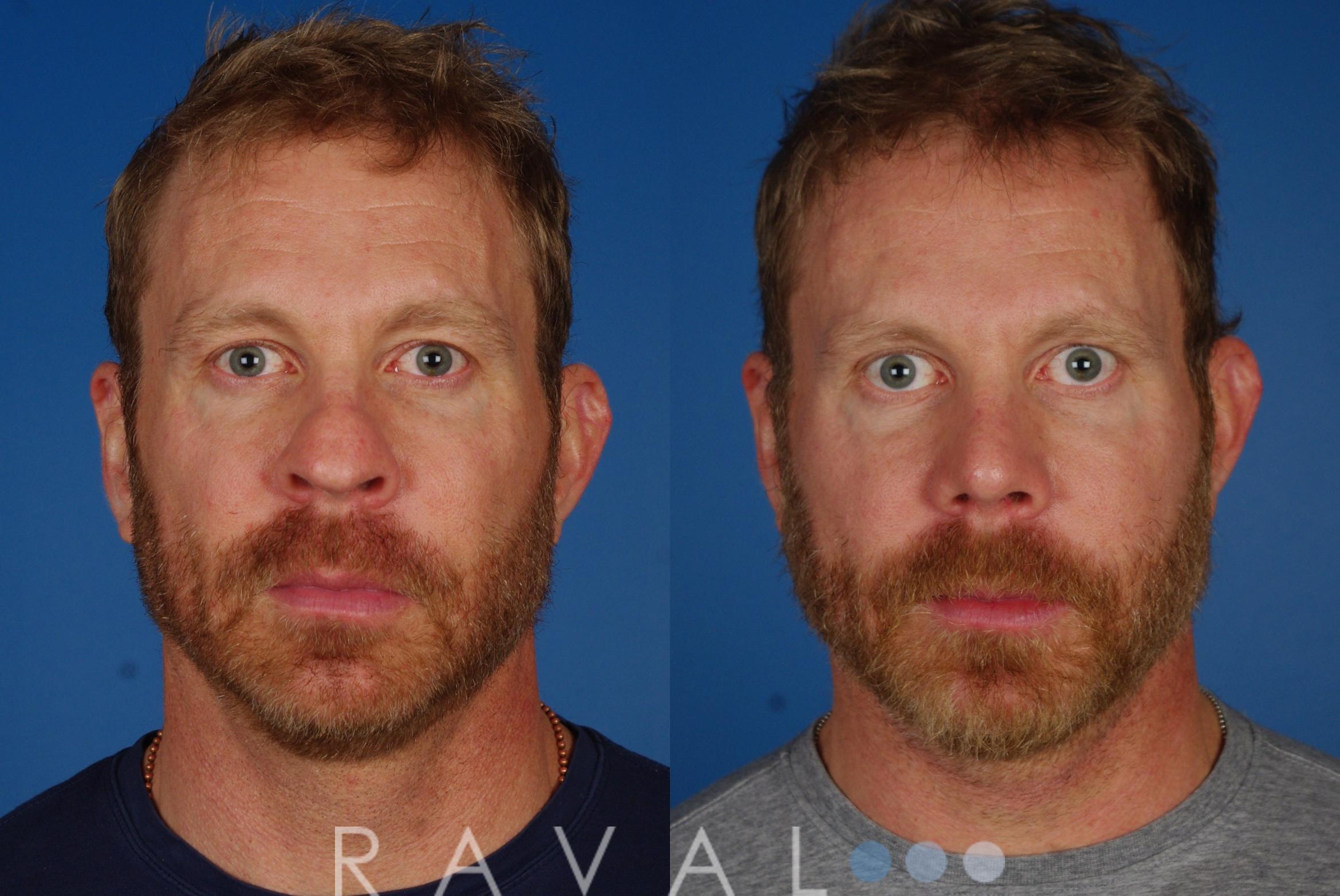 Before & After Revision Rhinoplasty Case 1051 View 1 View in Denver, CO