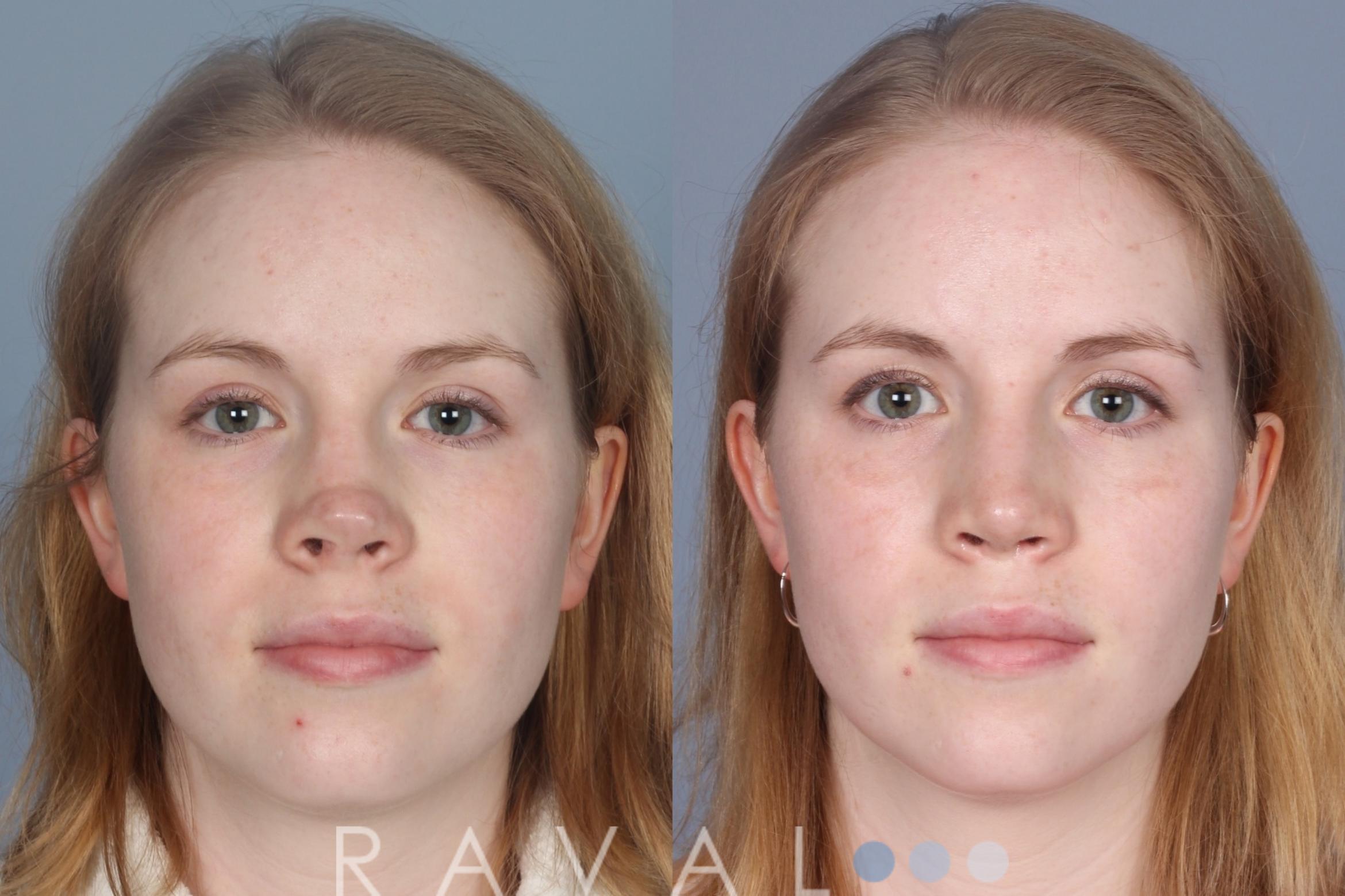 Before & After Revision Rhinoplasty Case 1205 Front View in Denver, CO