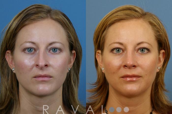 Before & After Rhinoplasty Case 1001 View 1 View in Denver, CO
