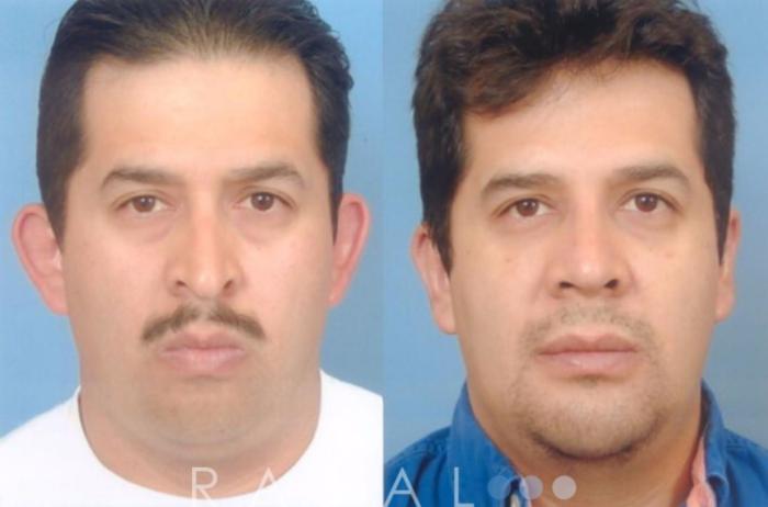 Before & After Rhinoplasty Case 1009 View 1 View in Denver, CO