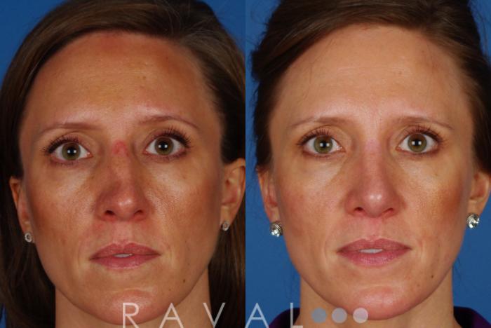 Before & After Rhinoplasty Case 1014 View 1 View in Denver, CO