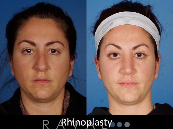 Before & After Rhinoplasty Case 1021 View 1 View in Denver, CO