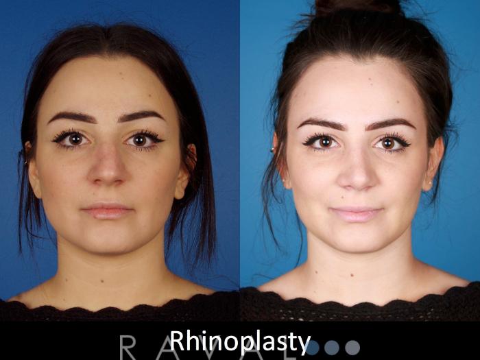 Before & After Rhinoplasty Case 1023 View 1 View in Denver, CO