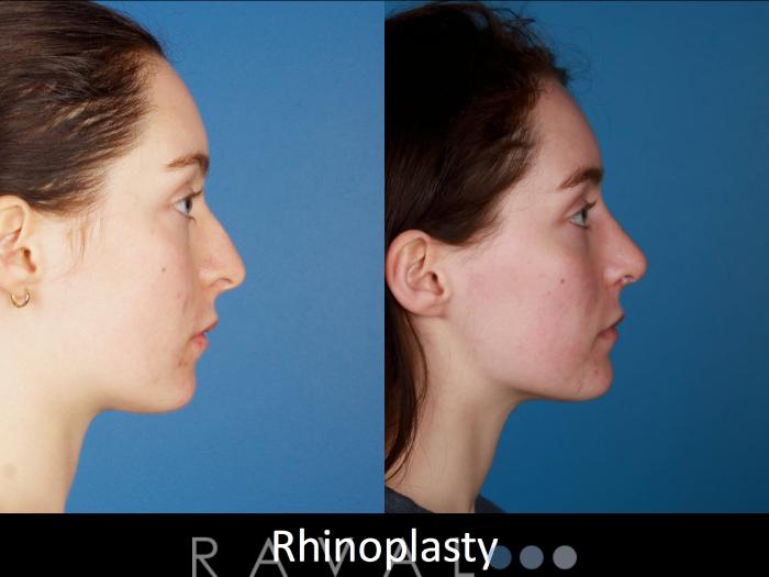 Before & After Rhinoplasty Case 1025 View 1 View in Denver, CO