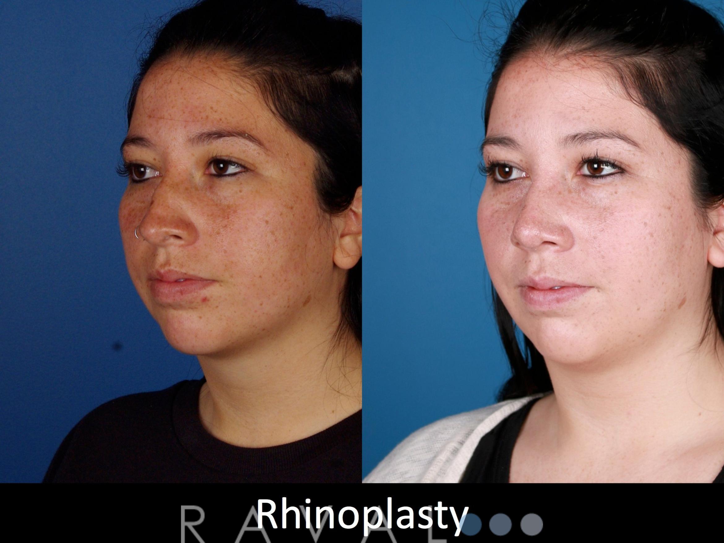 Before & After Rhinoplasty Case 1026 View 1 View in Denver, CO