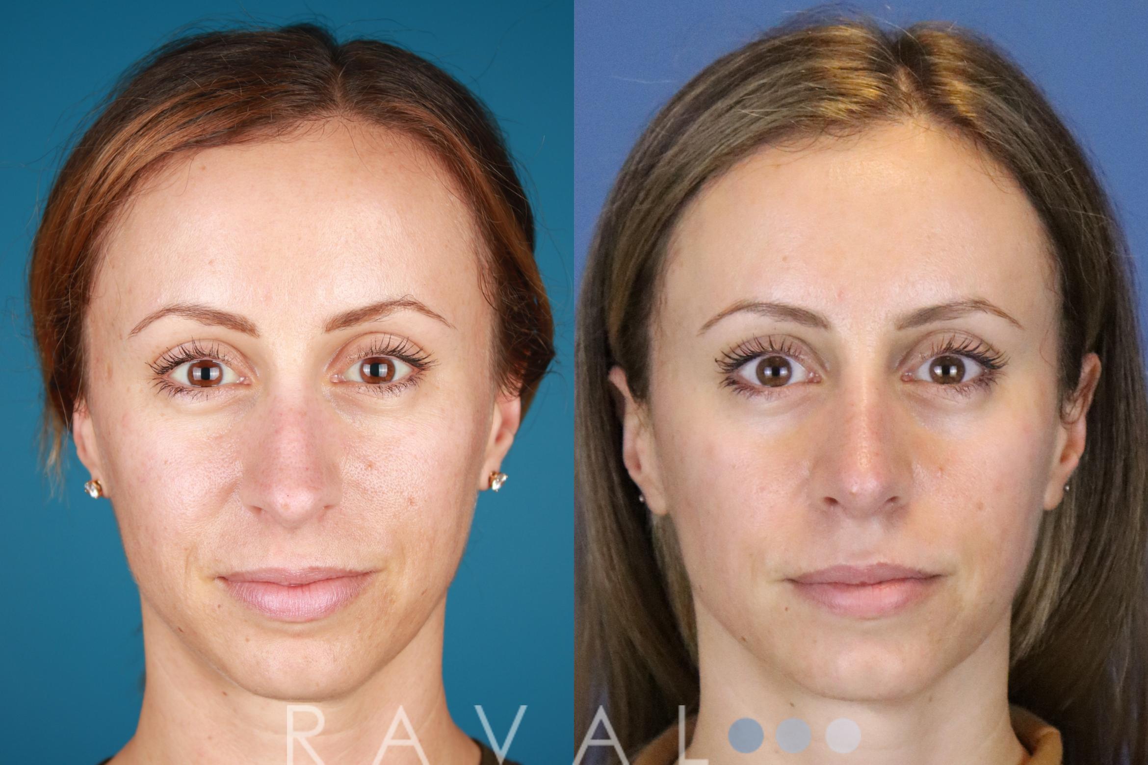 Before & After Rhinoplasty Case 1034 View 1 View in Denver, CO
