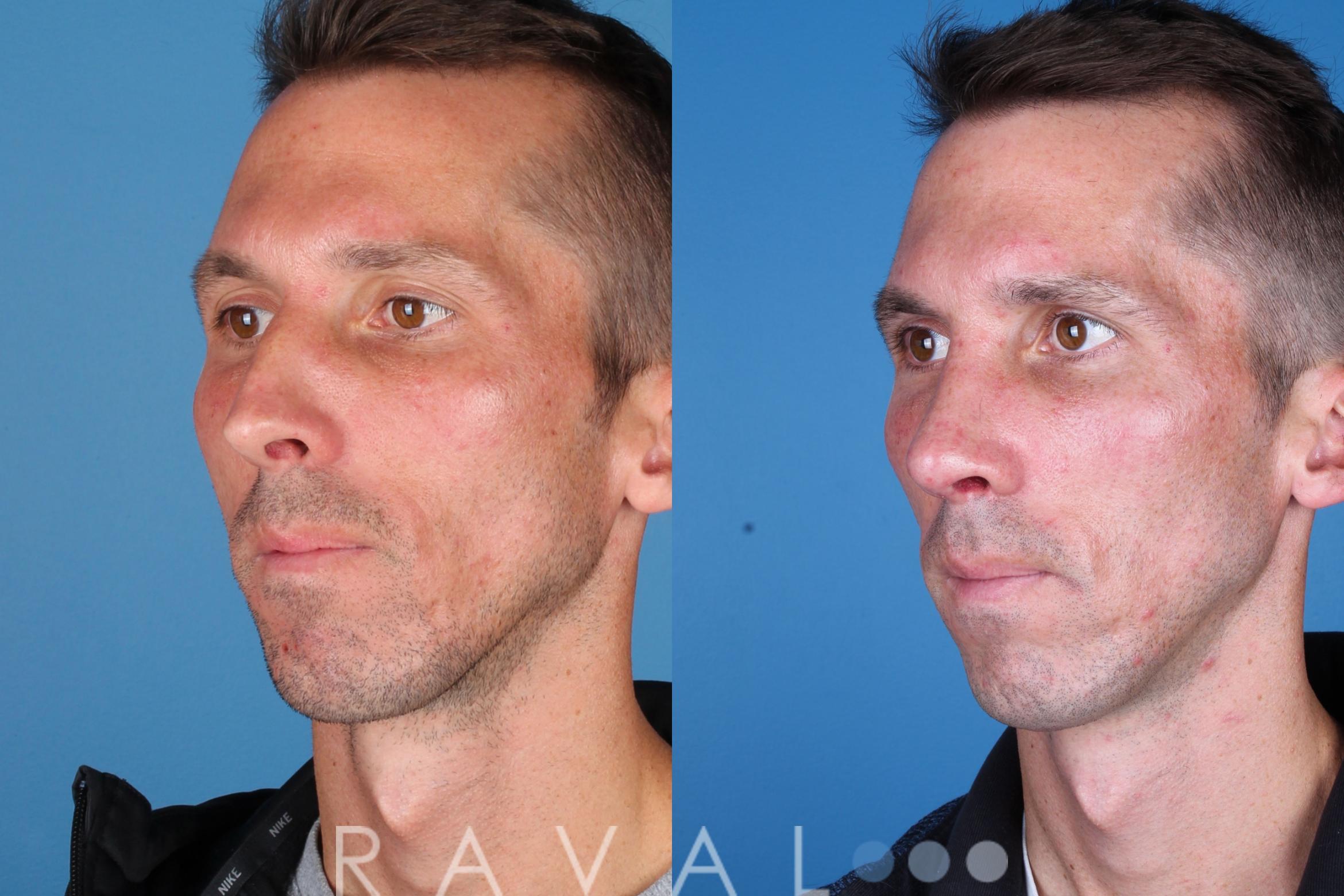 Before & After Rhinoplasty Case 1039 View 1 View in Denver, CO