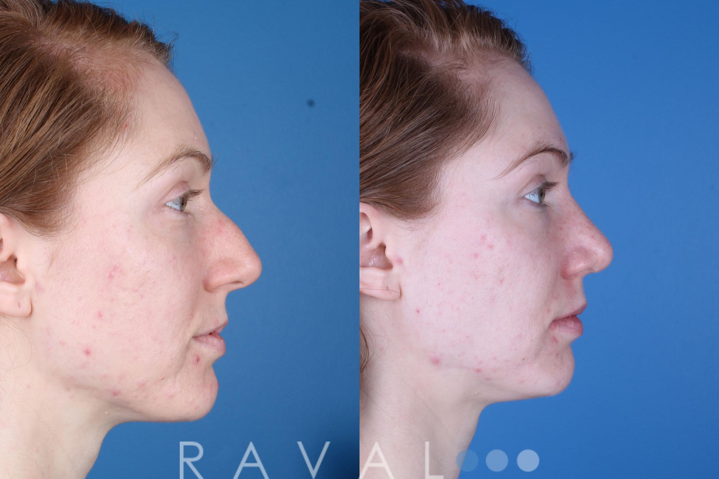 Before & After Rhinoplasty Case 1041 View 1 View in Denver, CO