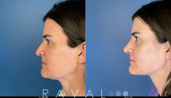 Before & After Rhinoplasty Case 1044 View 1 View in Denver, CO