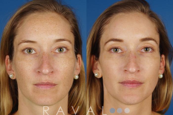 Before & After Skin Treatments Case 1085 View 1 View in Denver, CO
