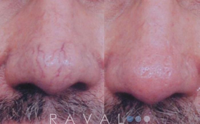 Before & After Skin Treatments Case 1091 View 1 View in Denver, CO