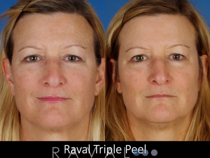 Before & After Skin Treatments Case 1100 View 1 View in Denver, CO