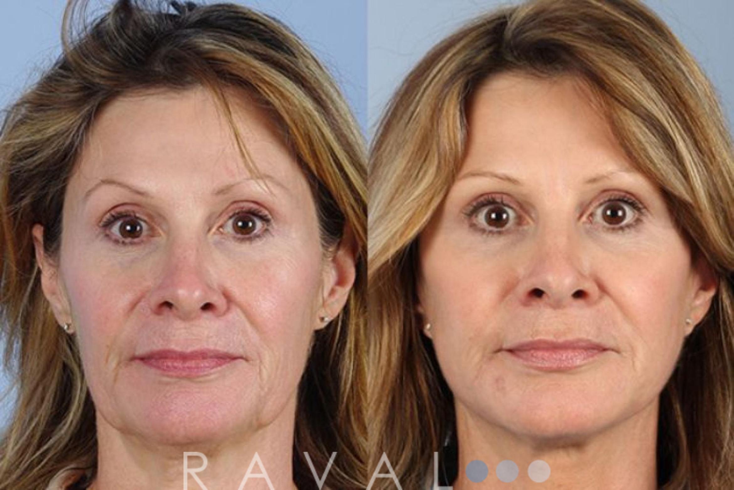 Before & After Botox & Dermal Fillers Case 1118 View 1 View in Denver, CO