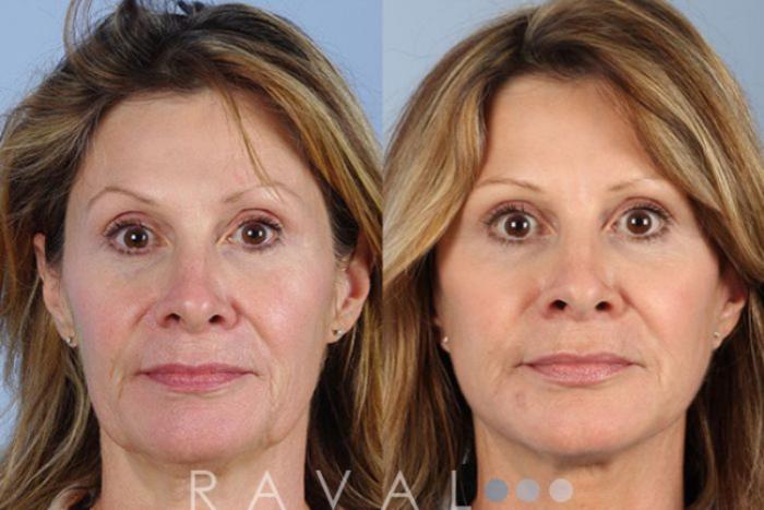 Before & After Botox & Dermal Fillers Case 1118 View 1 View in Denver, CO