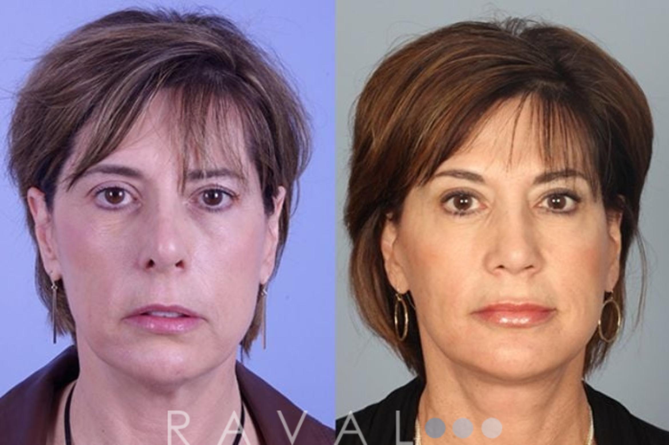 Before & After Botox & Dermal Fillers Case 1119 View 1 View in Denver, CO