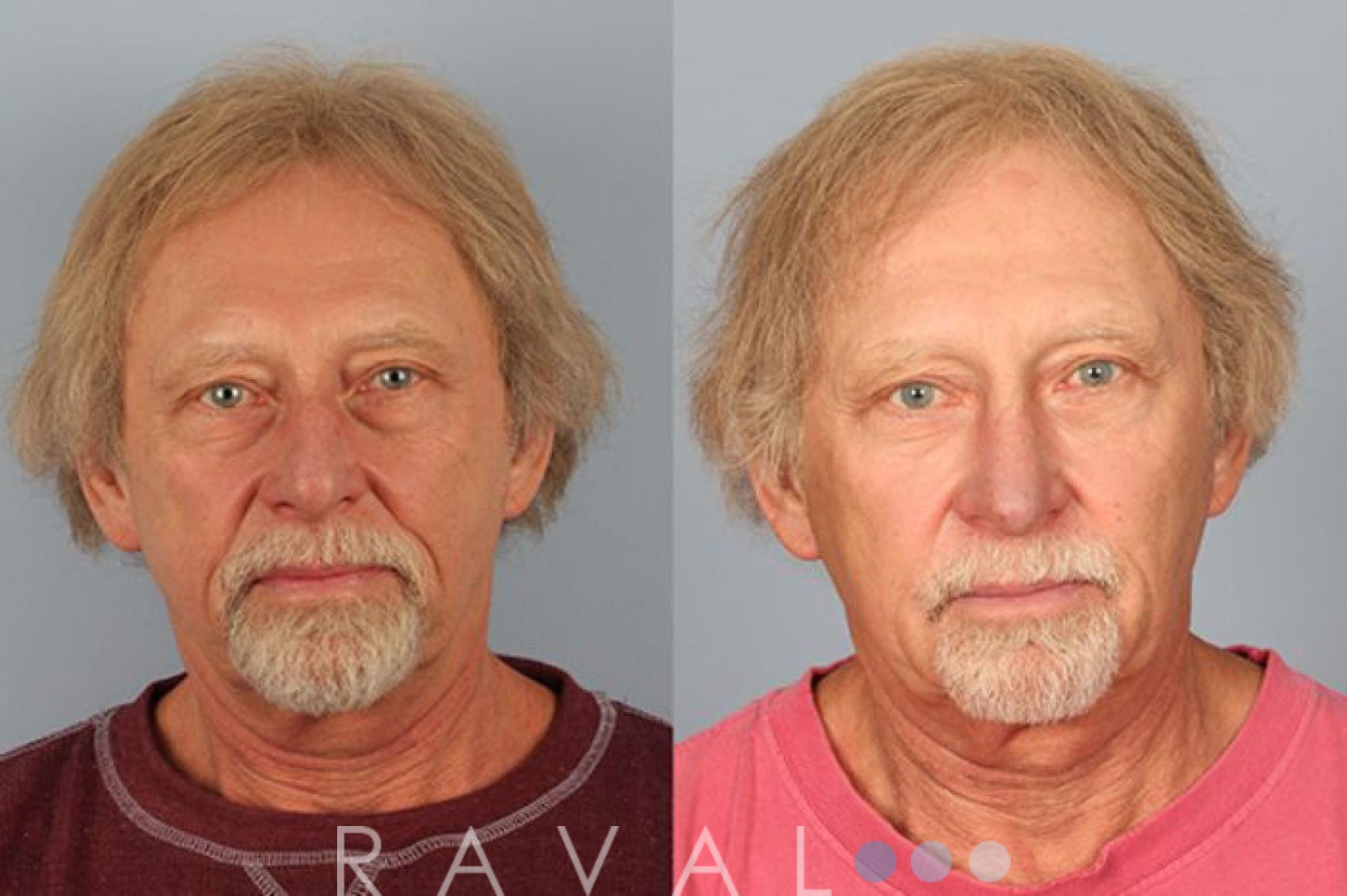 Before & After Botox & Dermal Fillers Case 1120 View 1 View in Denver, CO