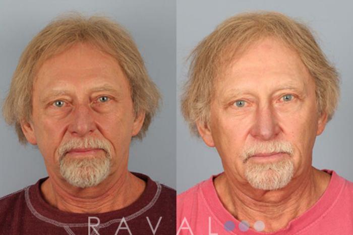 Before & After Botox & Dermal Fillers Case 1120 View 1 View in Denver, CO