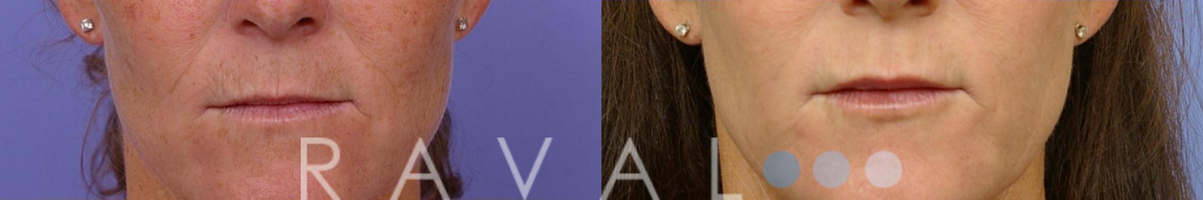 Before & After Botox & Dermal Fillers Case 1121 View 1 View in Denver, CO