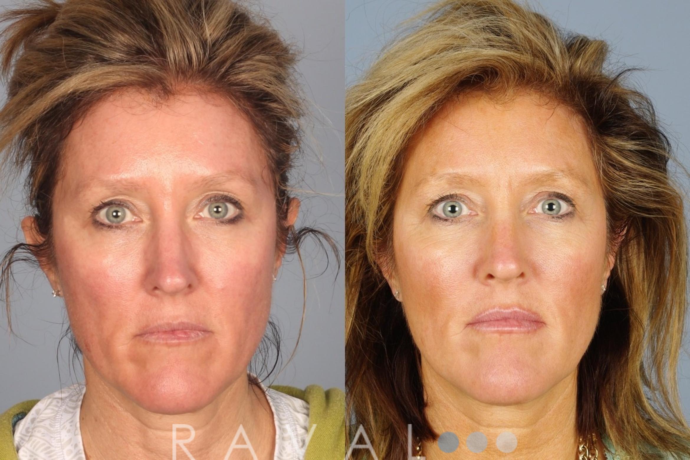 Before & After Botox & Dermal Fillers Case 1122 View 1 View in Denver, CO