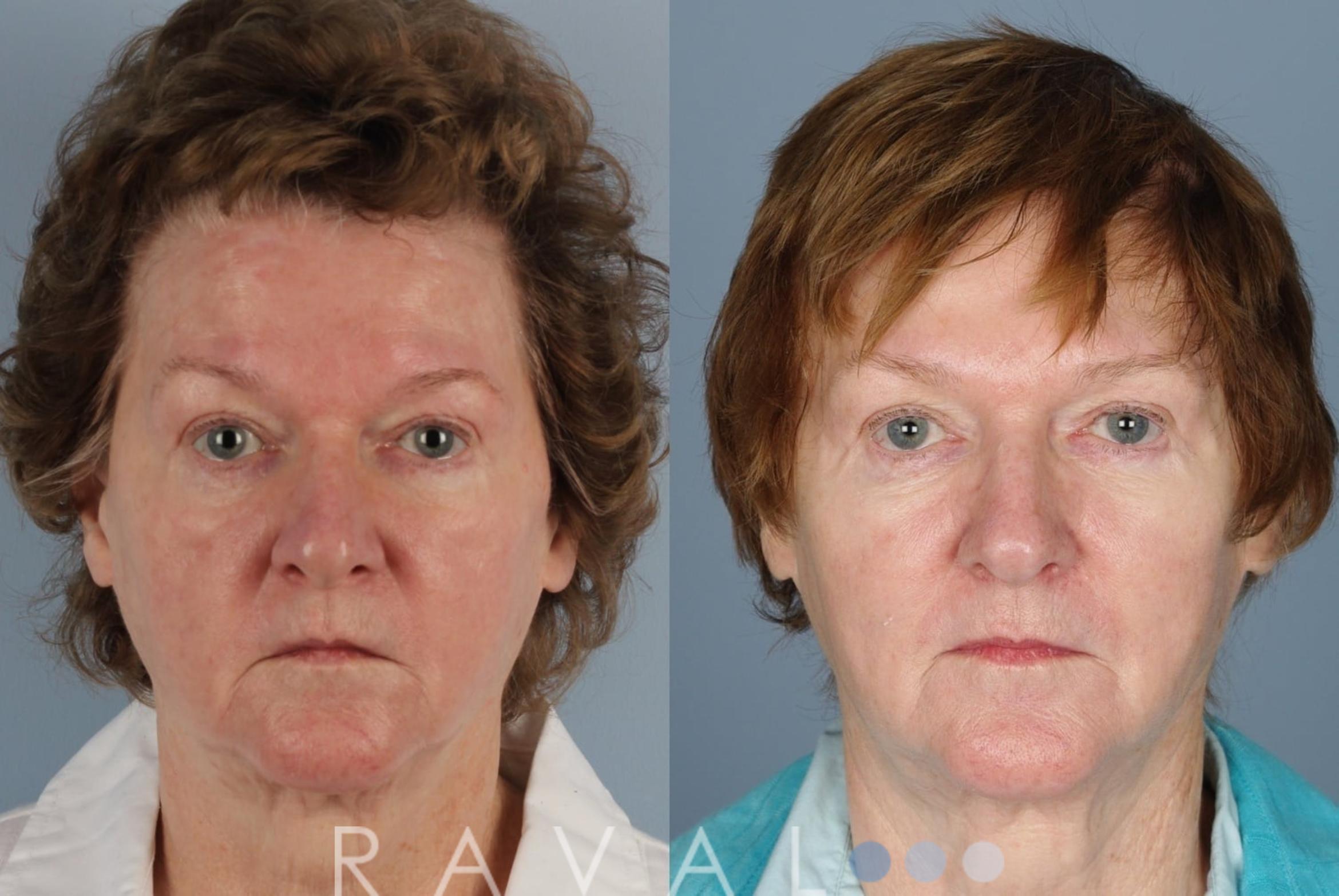 Before & After Botox & Dermal Fillers Case 1123 View 1 View in Denver, CO