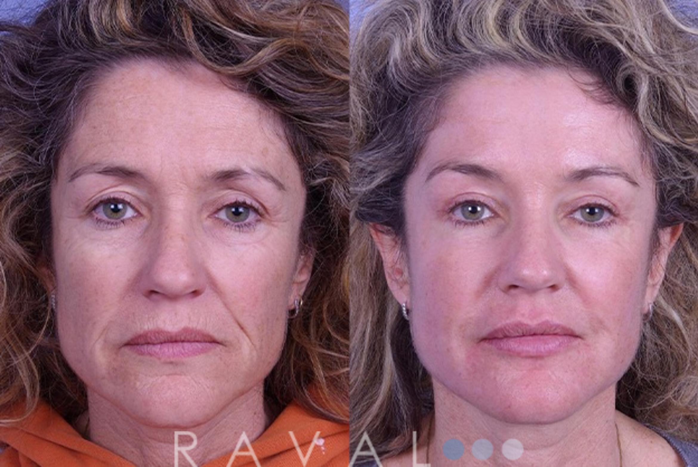 Before & After Botox & Dermal Fillers Case 1124 View 1 View in Denver, CO