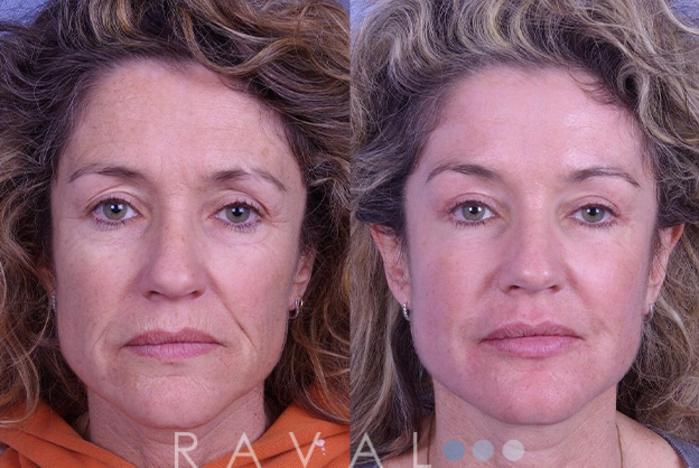 Before & After Botox & Dermal Fillers Case 1124 View 1 View in Denver, CO