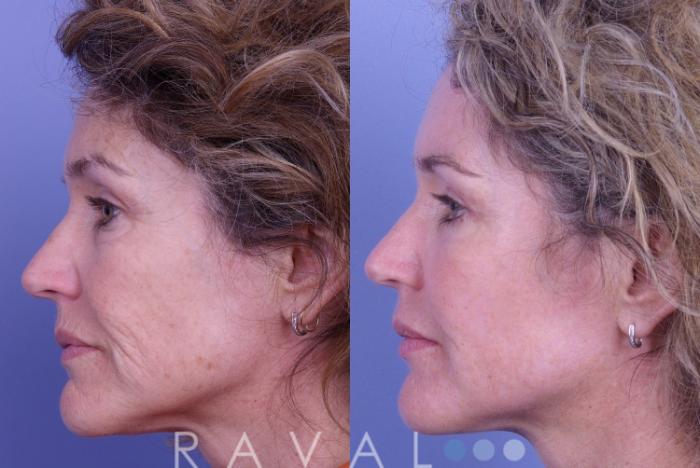Before & After Botox & Dermal Fillers Case 1124 View 2 View in Denver, CO