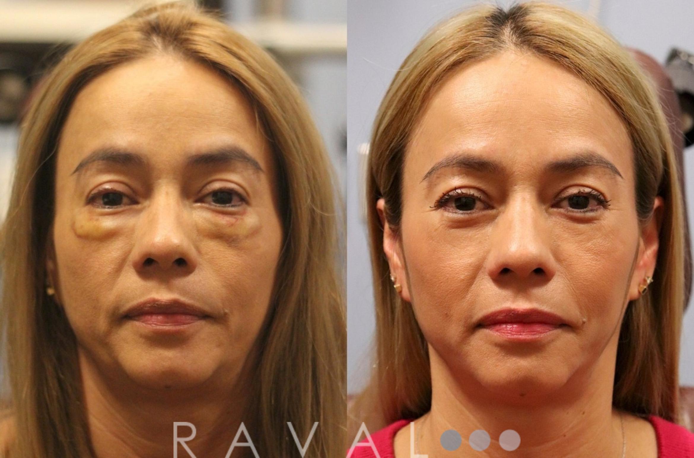 Before & After Botox & Dermal Fillers Case 1125 View 1 View in Denver, CO