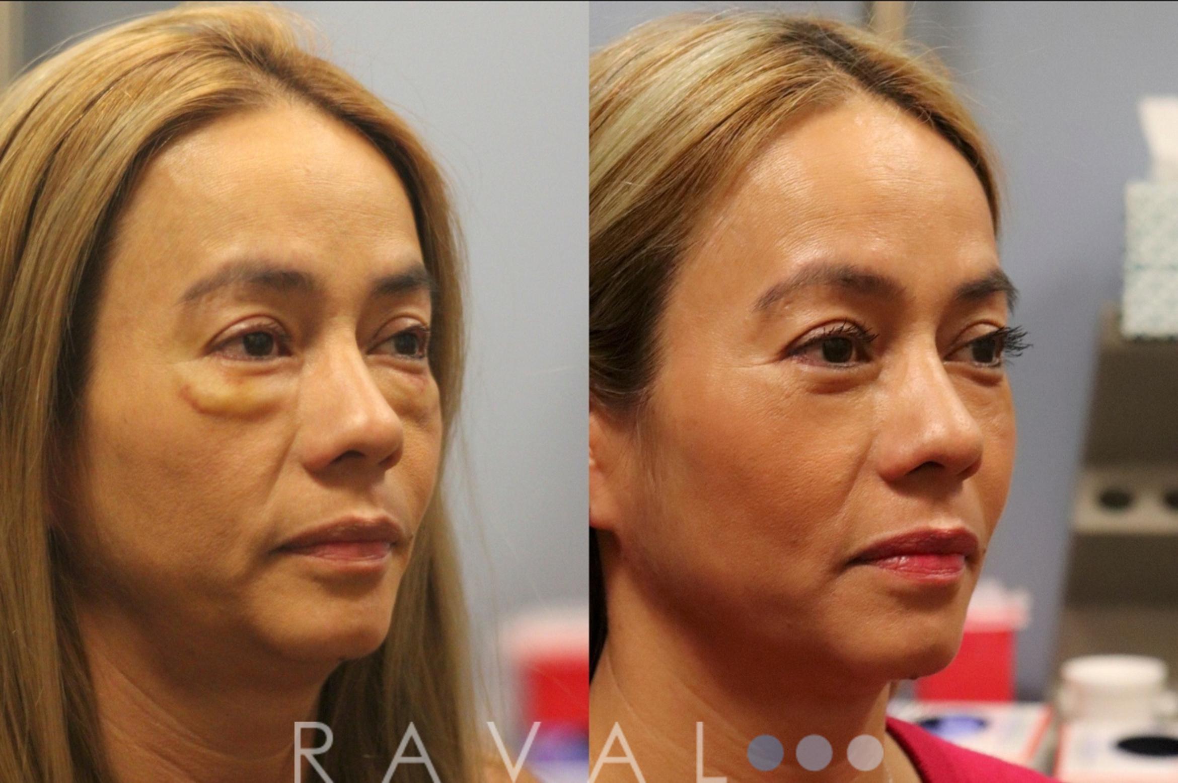Before & After Botox & Dermal Fillers Case 1125 View 2 View in Denver, CO