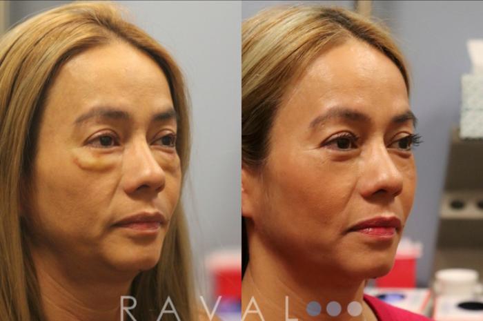 Before & After Botox & Dermal Fillers Case 1125 View 2 View in Denver, CO