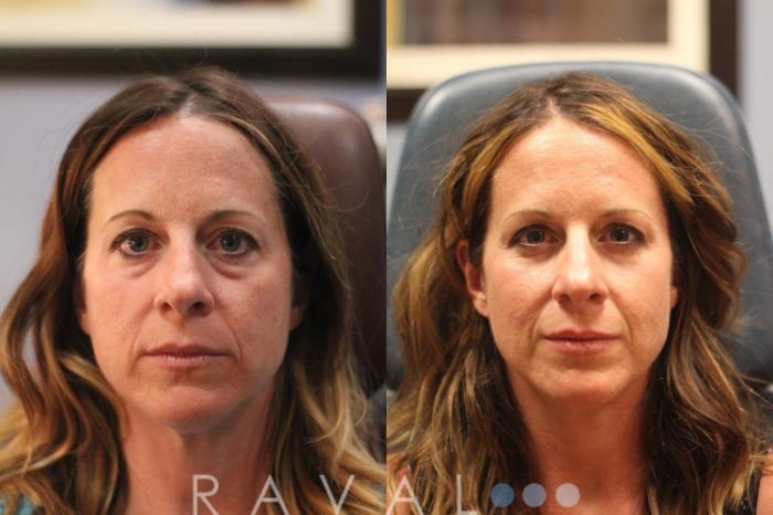 Before & After Botox & Dermal Fillers Case 1126 View 1 View in Denver, CO