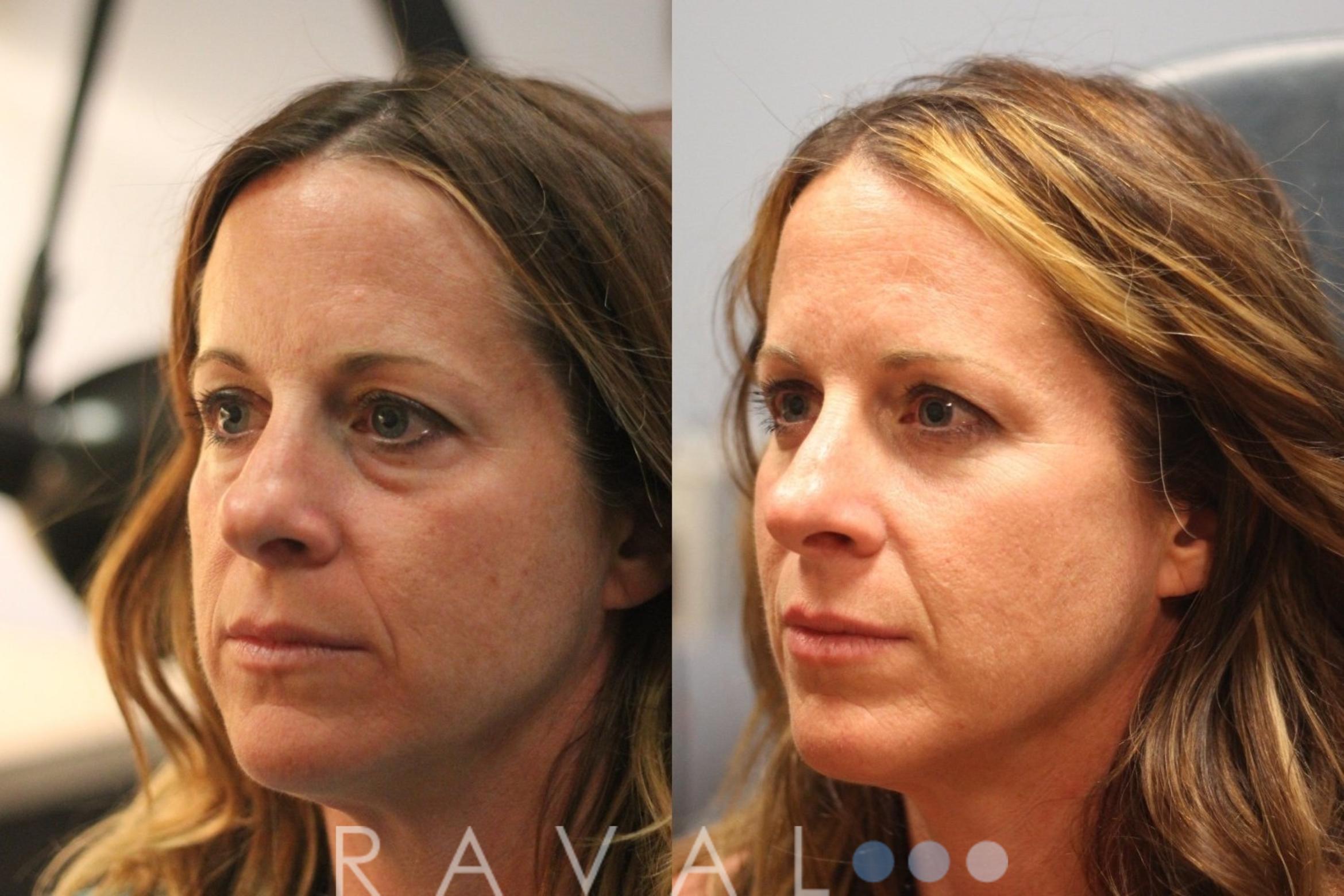 Before & After Botox & Dermal Fillers Case 1126 View 2 View in Denver, CO