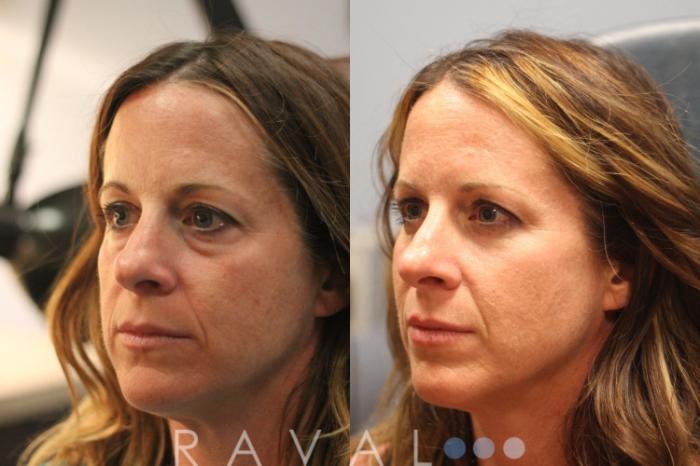 Before & After Botox & Dermal Fillers Case 1126 View 2 View in Denver, CO