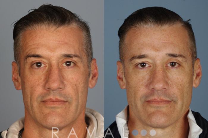 Before & After Botox & Dermal Fillers Case 1127 View 1 View in Denver, CO