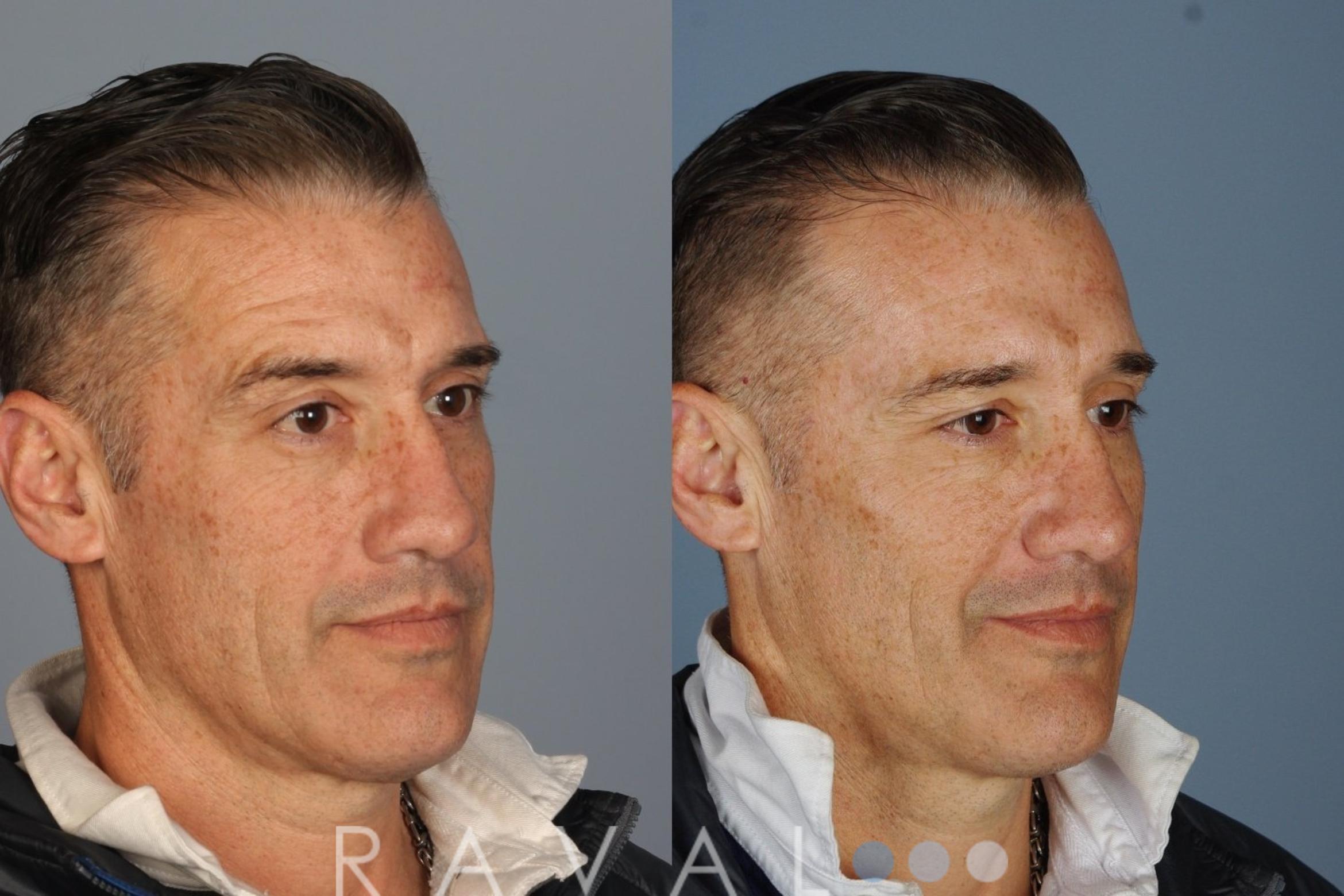 Before & After Botox & Dermal Fillers Case 1127 View 2 View in Denver, CO