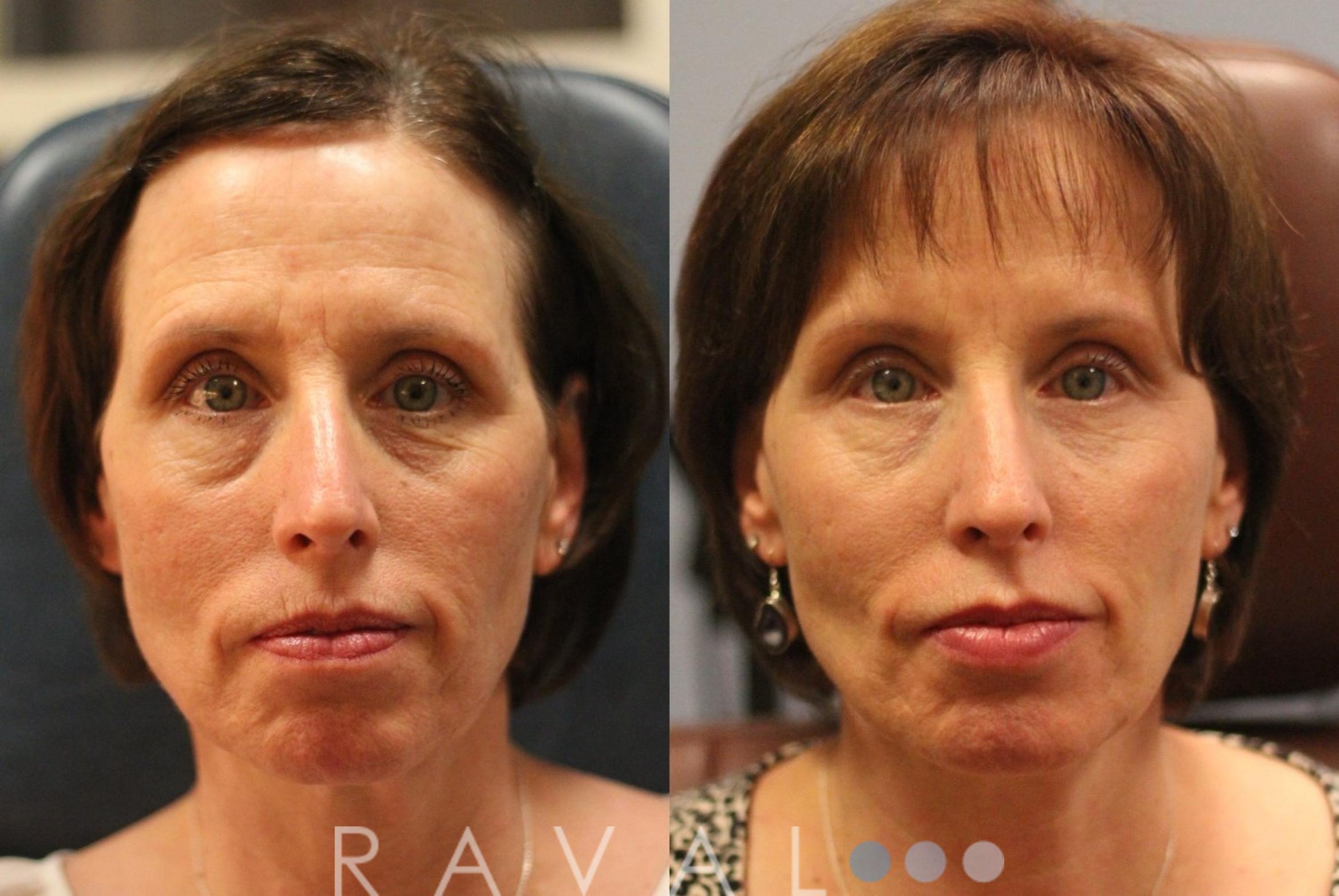 Before & After Botox & Dermal Fillers Case 1128 View 1 View in Denver, CO