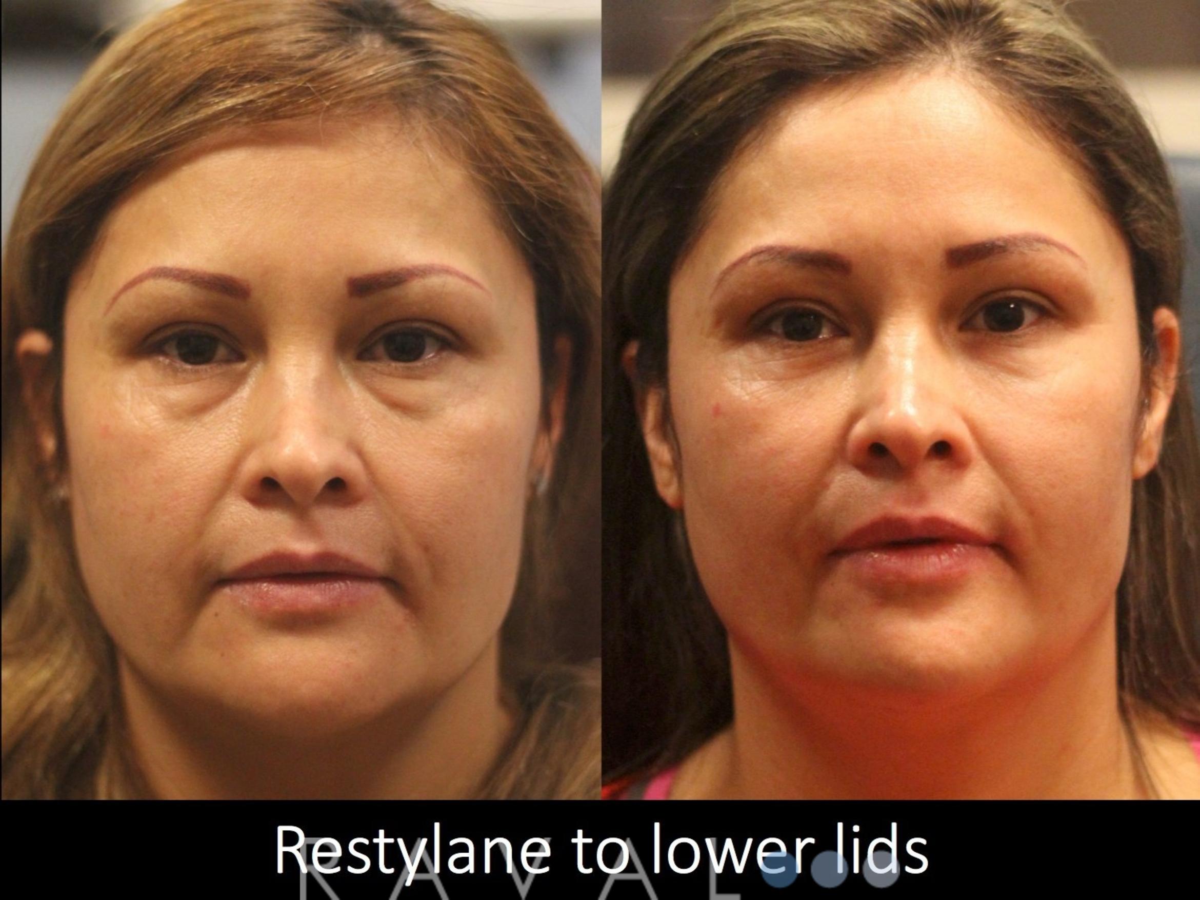 Before & After Botox & Dermal Fillers Case 1129 View 1 View in Denver, CO