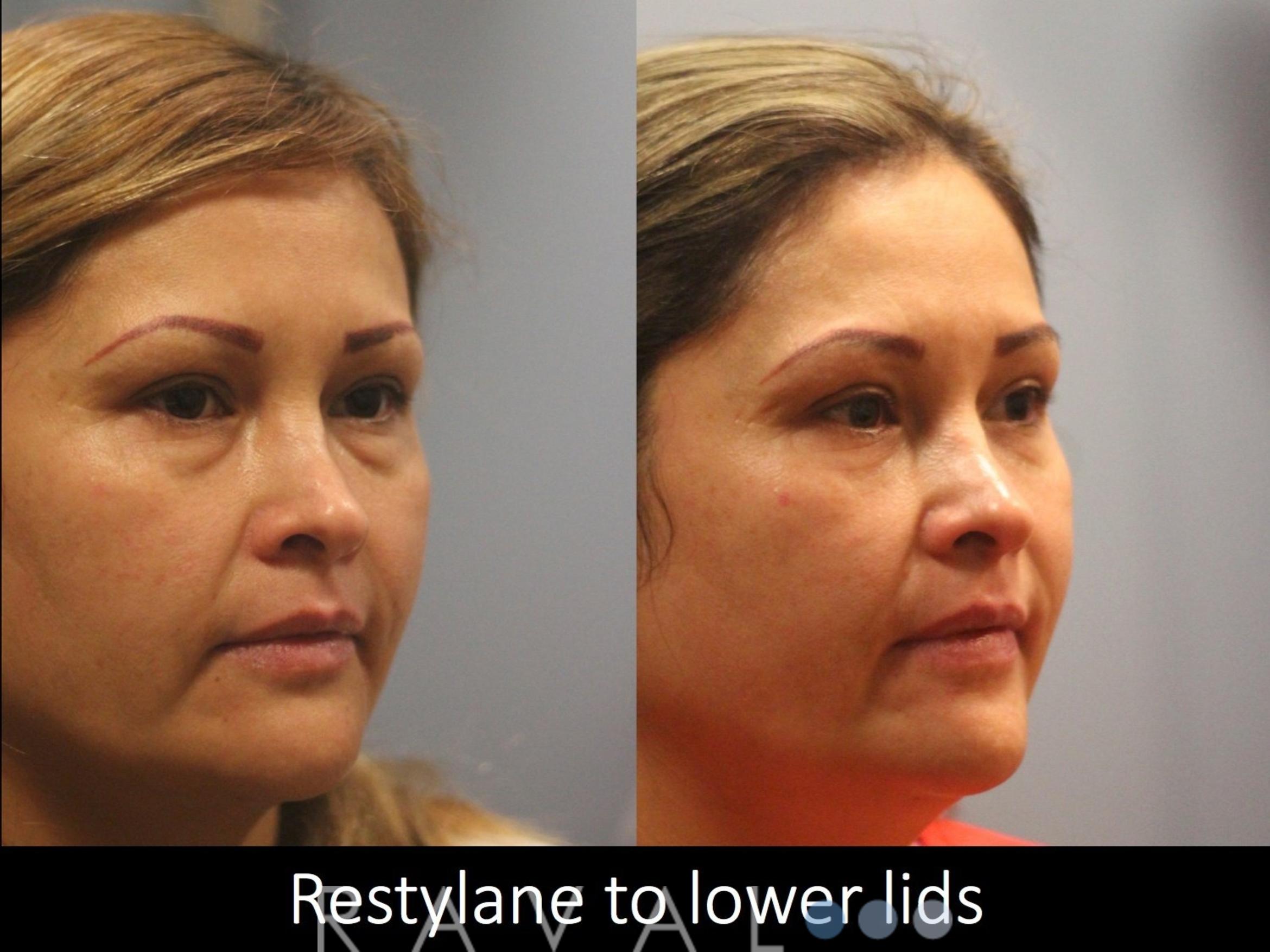 Before & After Botox & Dermal Fillers Case 1129 View 2 View in Denver, CO