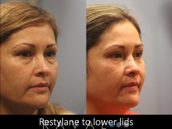 Before & After Botox & Dermal Fillers Case 1129 View 2 View in Denver, CO