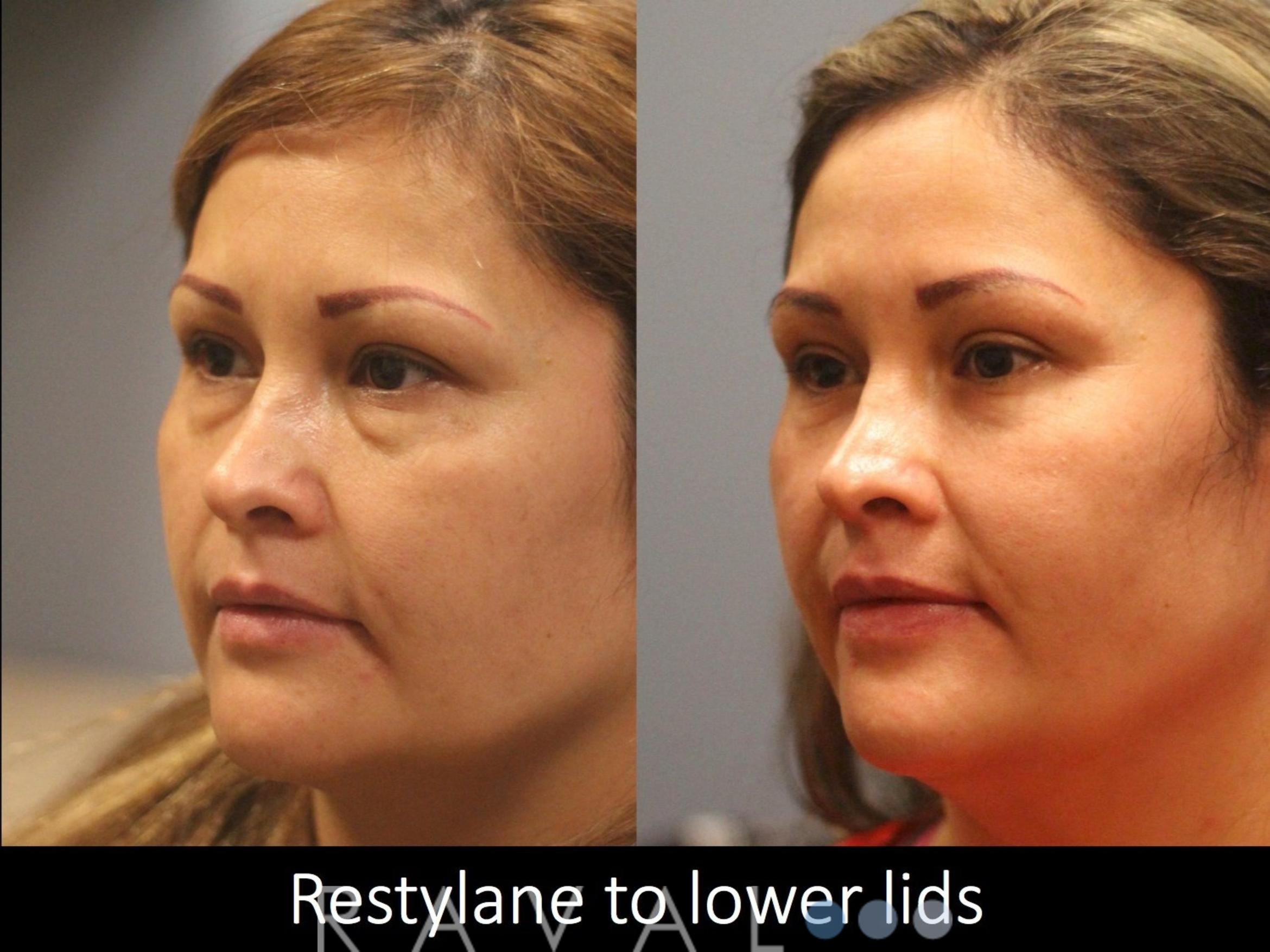 Before & After Botox & Dermal Fillers Case 1129 View 3 View in Denver, CO